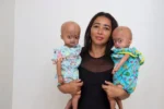 Caso raro – Conheça as gêmeas brasileiras com síndrome de Benjamin Button