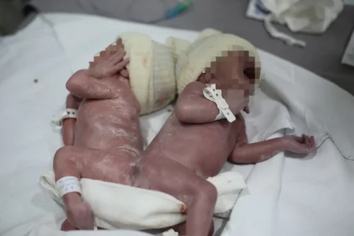 Saúde – Gêmeos unidos por osso da coluna nascem no Paraná
